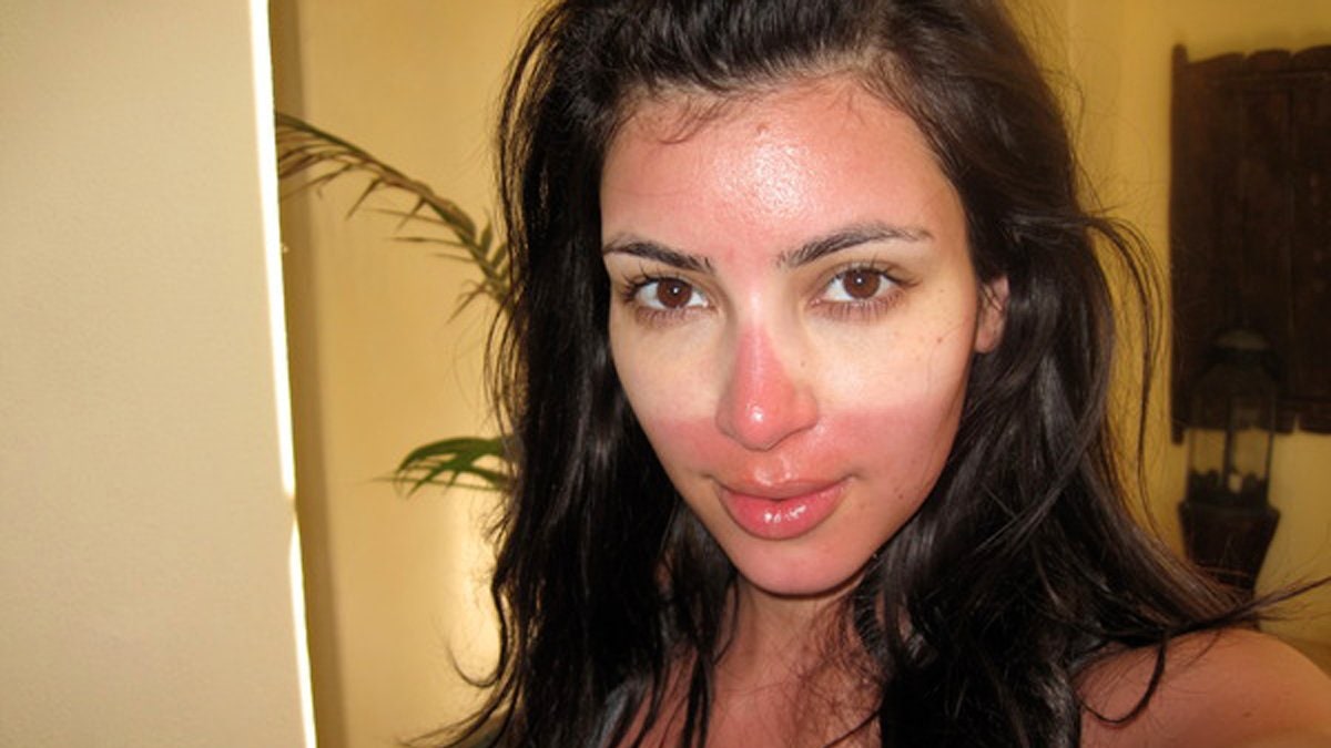 Here’s How to Treat a Bad Sunburn, Fast