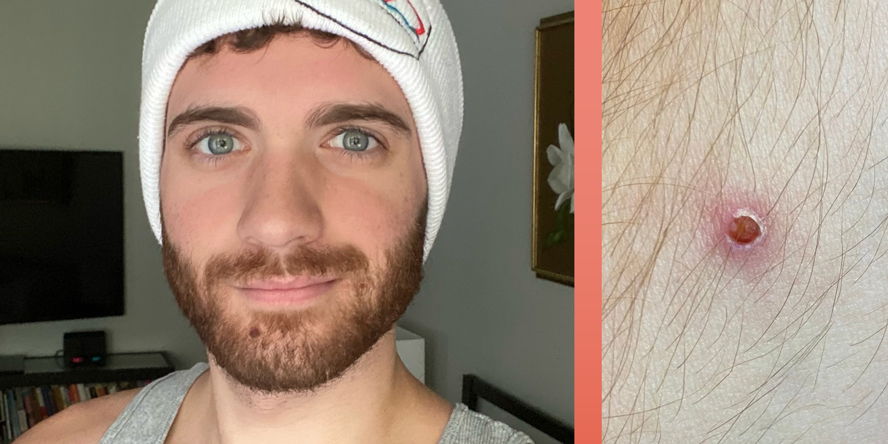 I Was Diagnosed With Monkeypox and the Symptoms Are Pretty Brutal