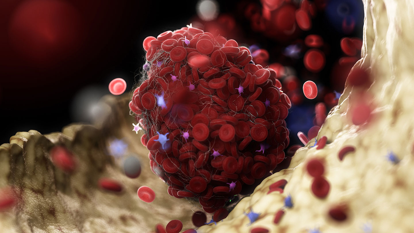 People with rare blood clots after a COVID-19 jab share an uncommon immune response